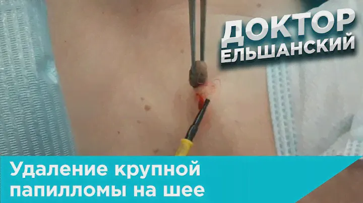 Удаление крупной папилломы на шее