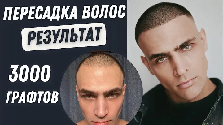 Пересадка Волос в Турции До и После 3000 графтов | Пересадка волос в Турции |Передка волос результат