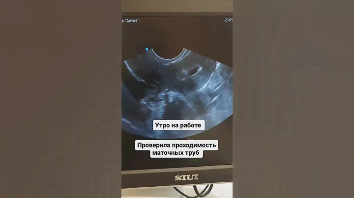 Проходимость маточных труб, оценка на УЗИ. #гинеколог #гинекологмосква
