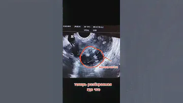 как выглядит миома матки на УЗИ 👍👌 #гинеколог