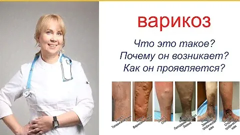 Самое полное объяснение что такое варикоз, почему и у кого  он появляется?