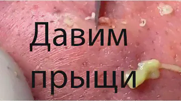 Мега огромная подборка удаления прыщей, чёрных точек, угрей. #22